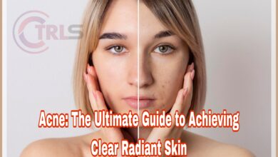 Acne :The Ultimate Guide to Achieving Clear, Radiant Skin